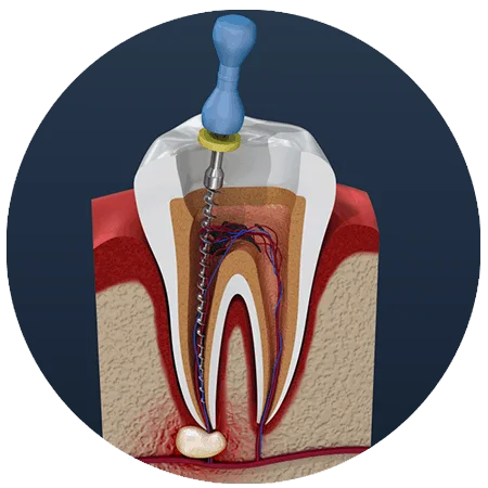 Endodontics (Root Canal)